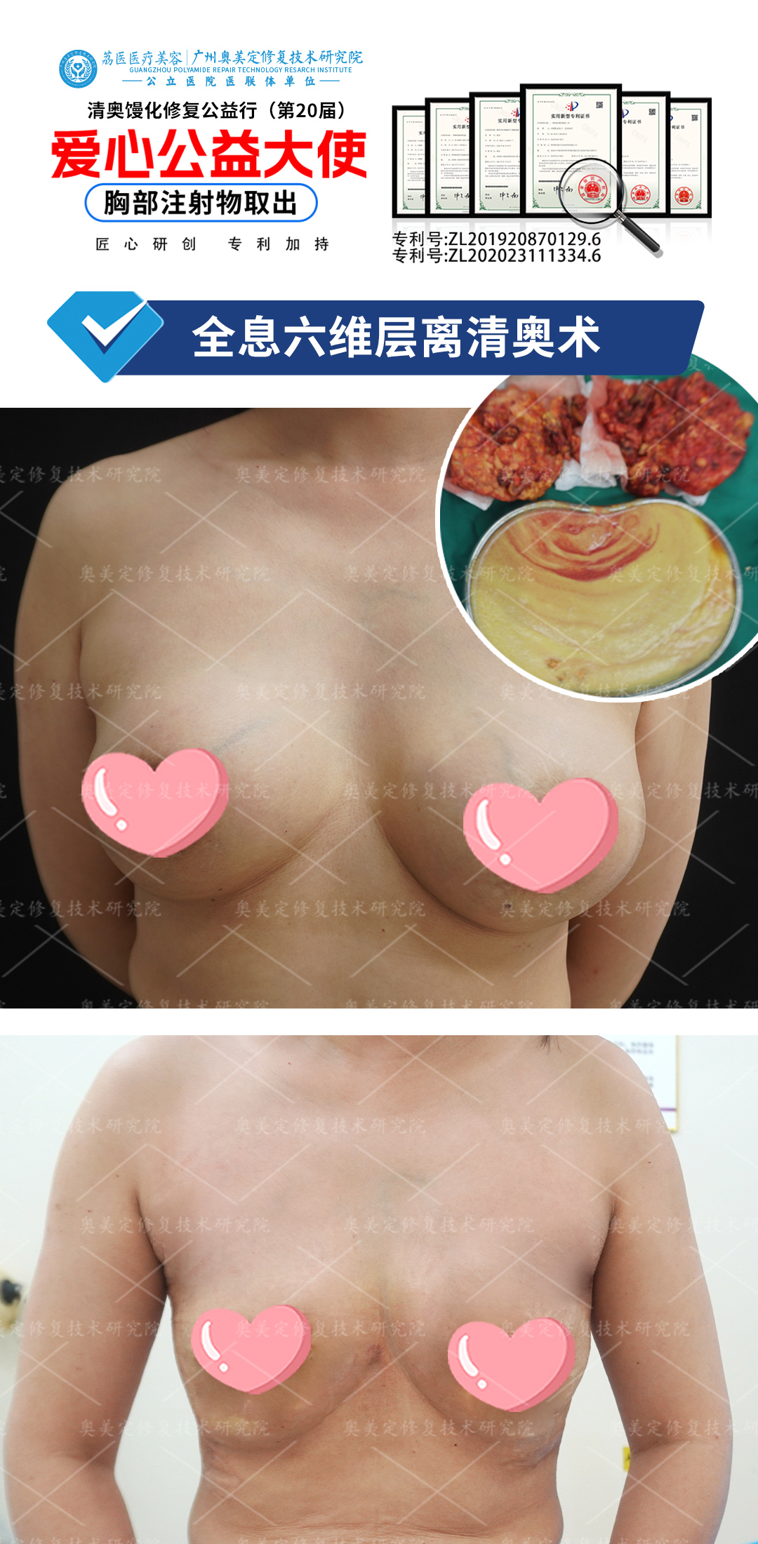 胸部注射非法材料隆胸后能取吗？