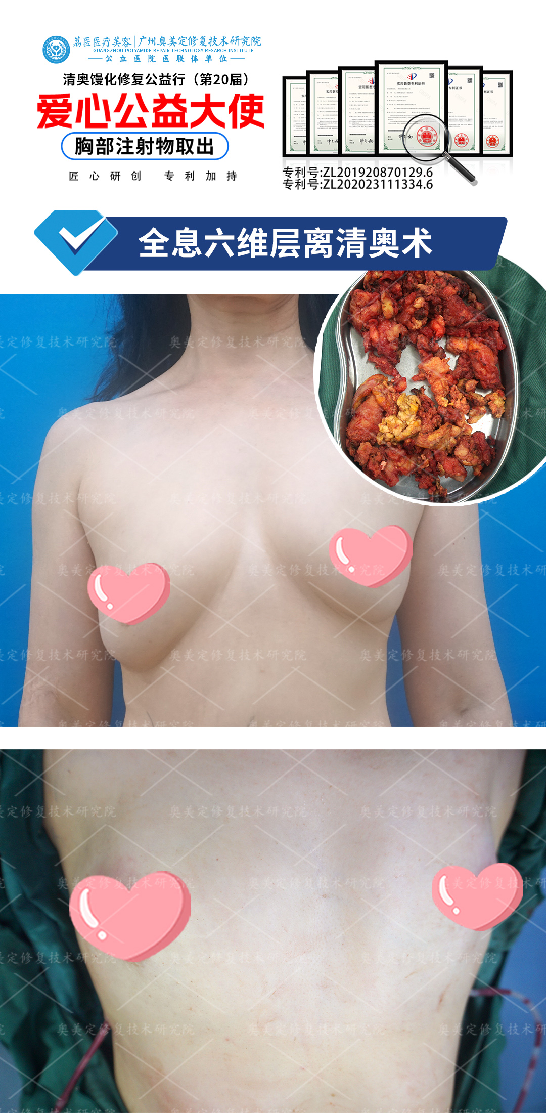 奥美定潜伏多年！来院成功取出修复