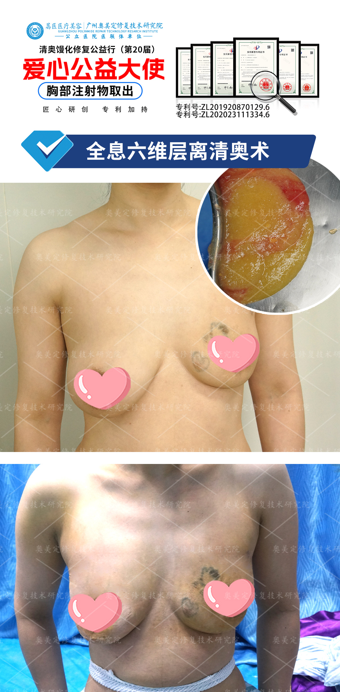 奥美定隆胸后肿胀异常增大，20年“美丽陷阱”终于爆发