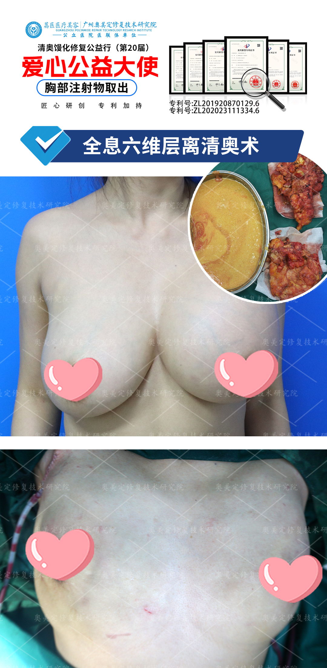 奥美定隆胸20年后还能取出吗？