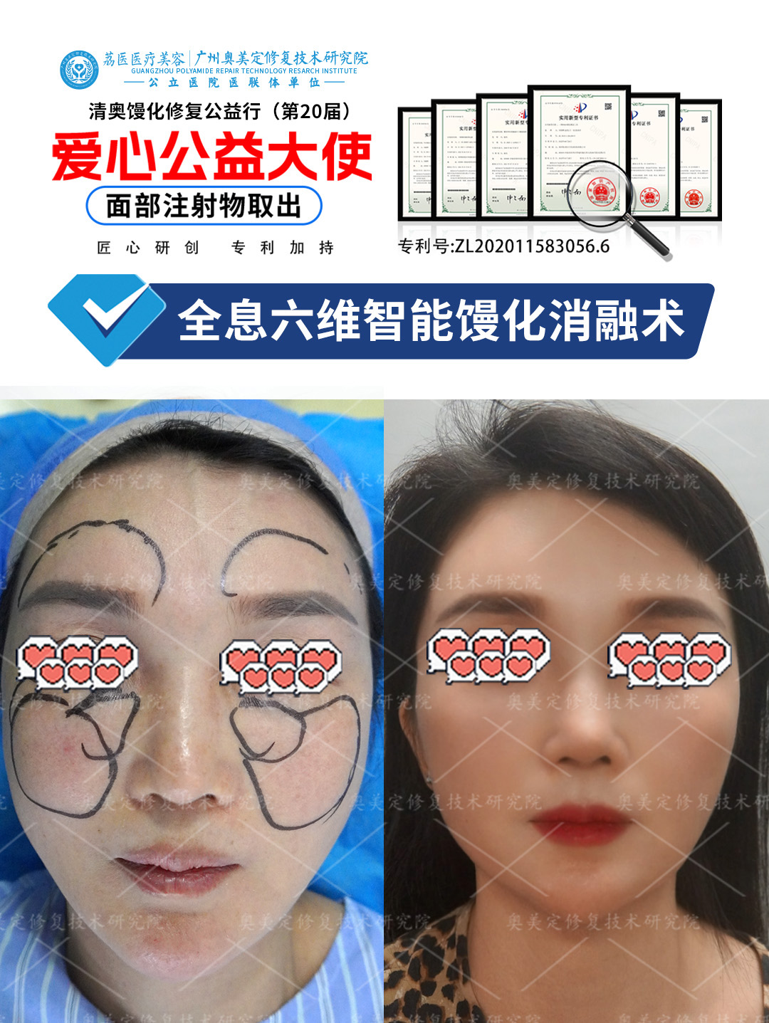 一针生长肽，脸肿到僵硬变形