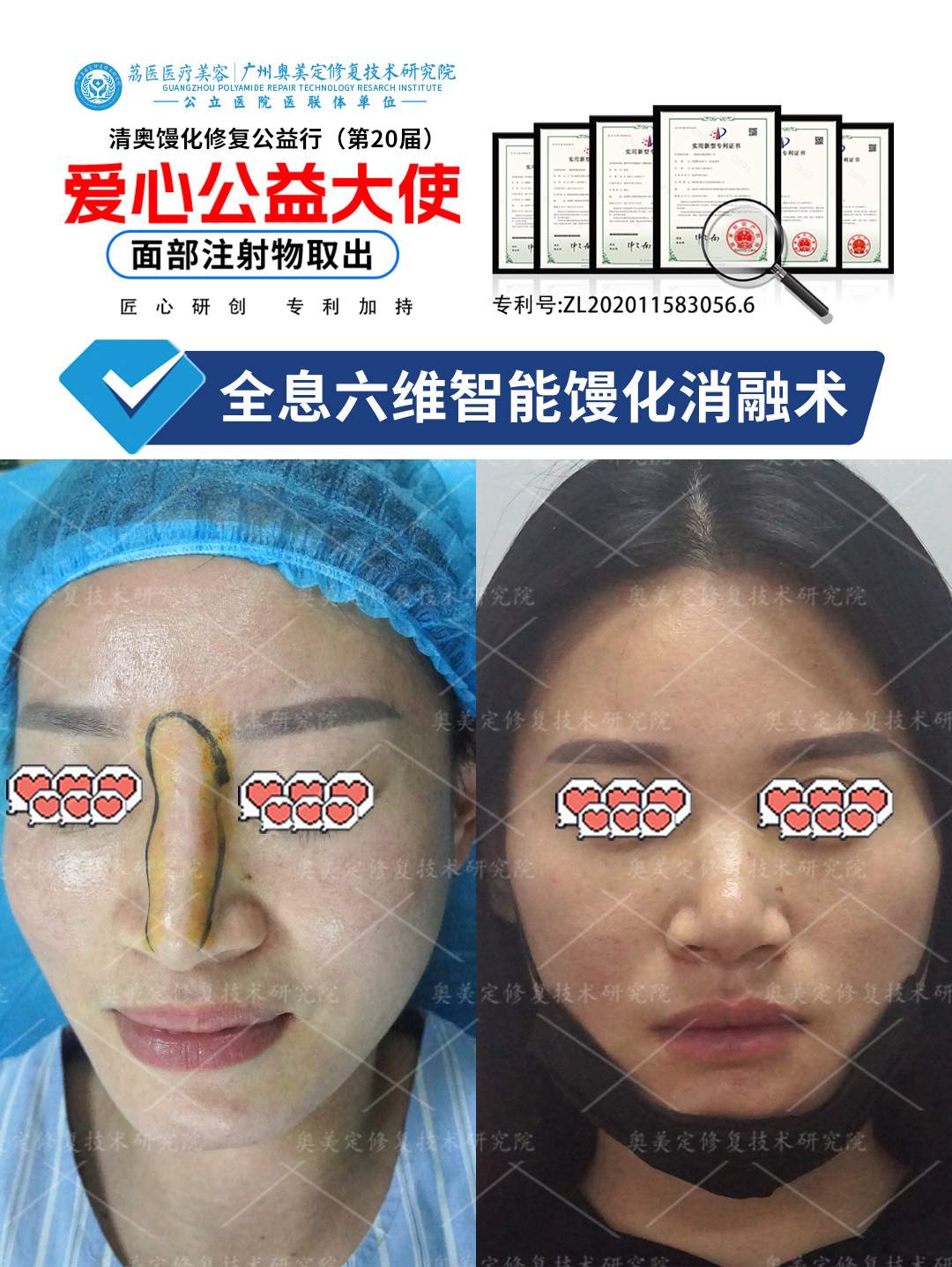 鼻部注射取出修复