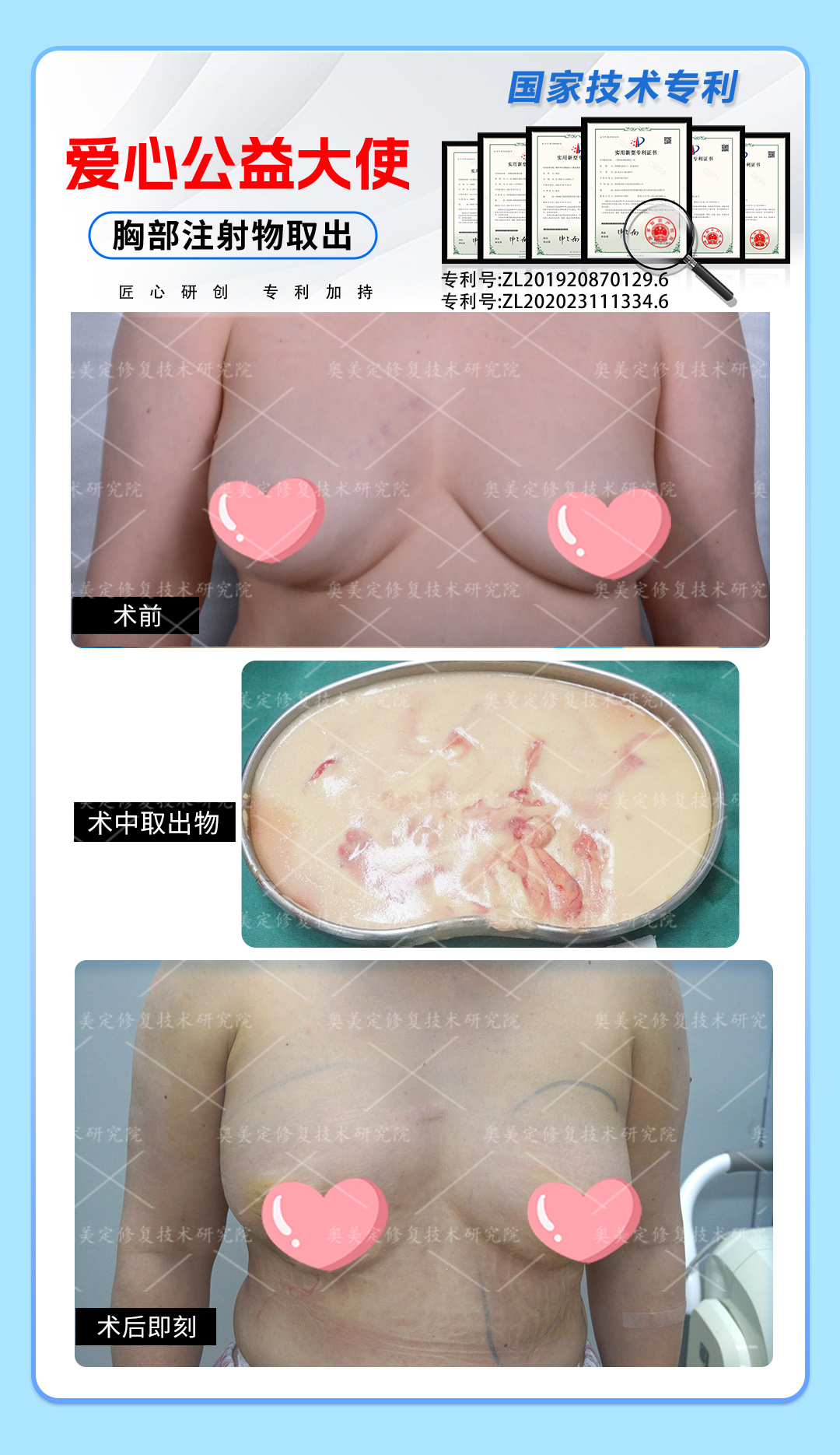 奥美定隆胸20年，取出修复重获新生