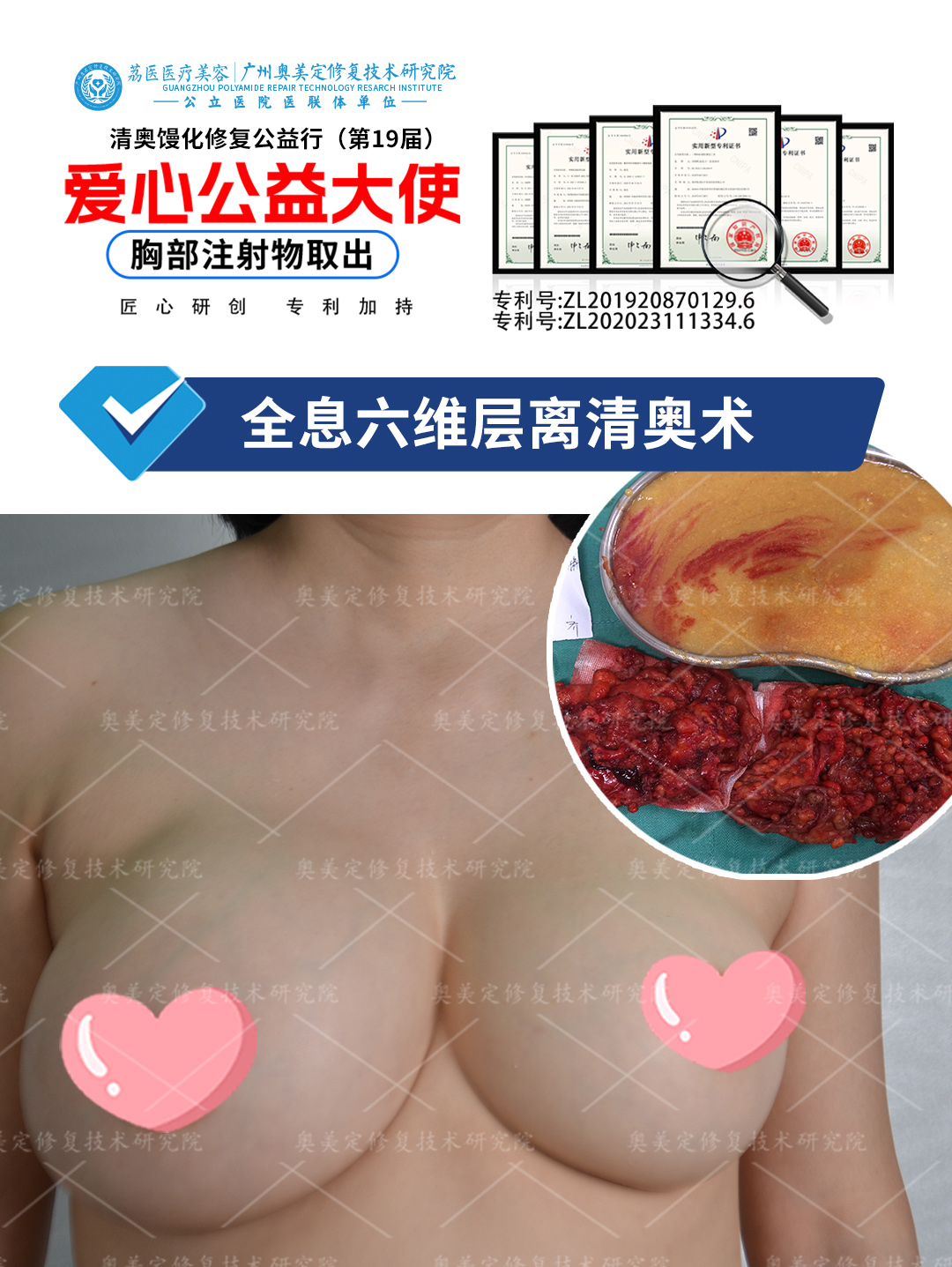 广东奥美定隆胸取出修复