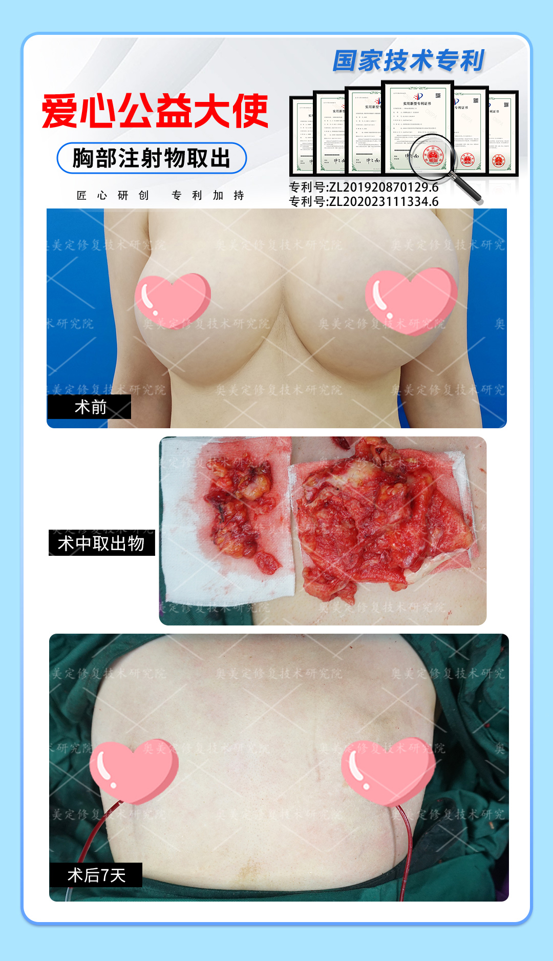 胸部捷克水分子取出