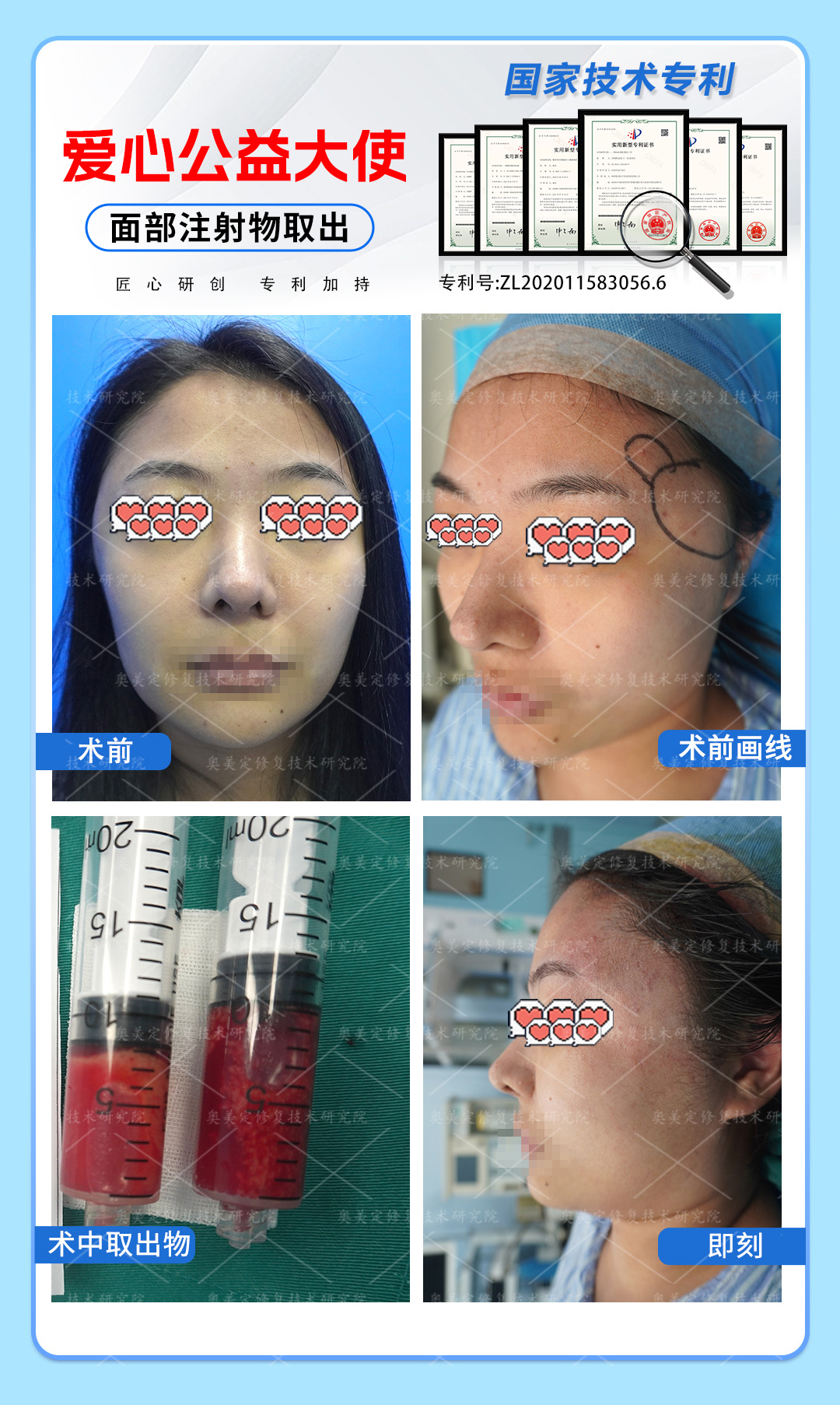 35岁女士太阳穴生长因子取出修复：告别“突兀太阳穴”