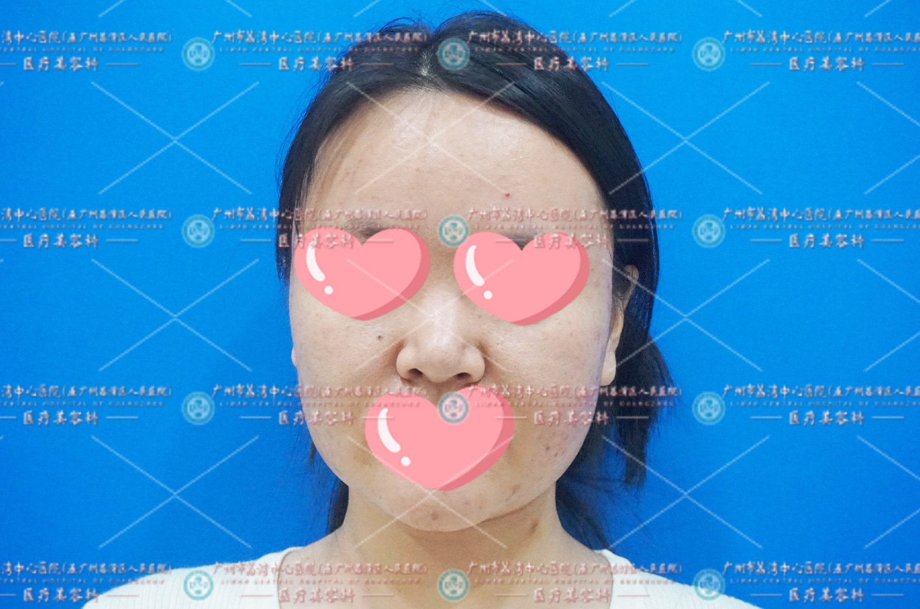 生长因子丰苹果肌注射增生不自然如何取出修复？