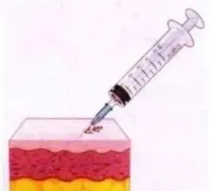 超全面的「玻尿酸」高阶注射使用指南来了！