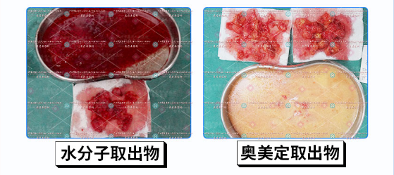 捷克水分子注射丰胸要不要取出来？