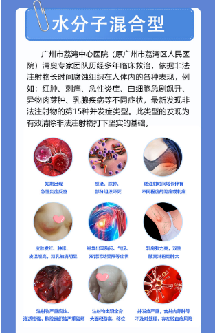 捷克水分子注射隆胸的症状有哪些？