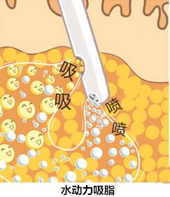 曾浩吸脂会反弹吗？