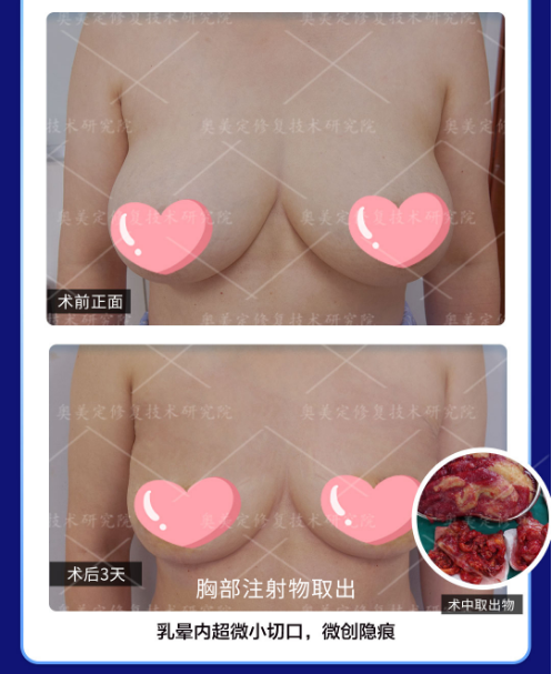 奥美定注射多久后遗症会显现