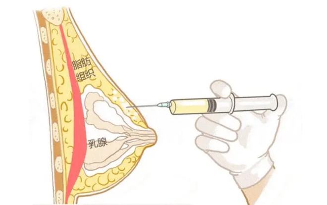 隆胸哪种方式最安全？