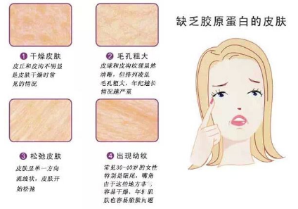 玻尿酸VS胶原蛋白填充：你的皮肤更适合哪种？