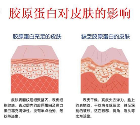 胶原蛋白填充能维持多久——从科学视角解析维持周期与长效策略