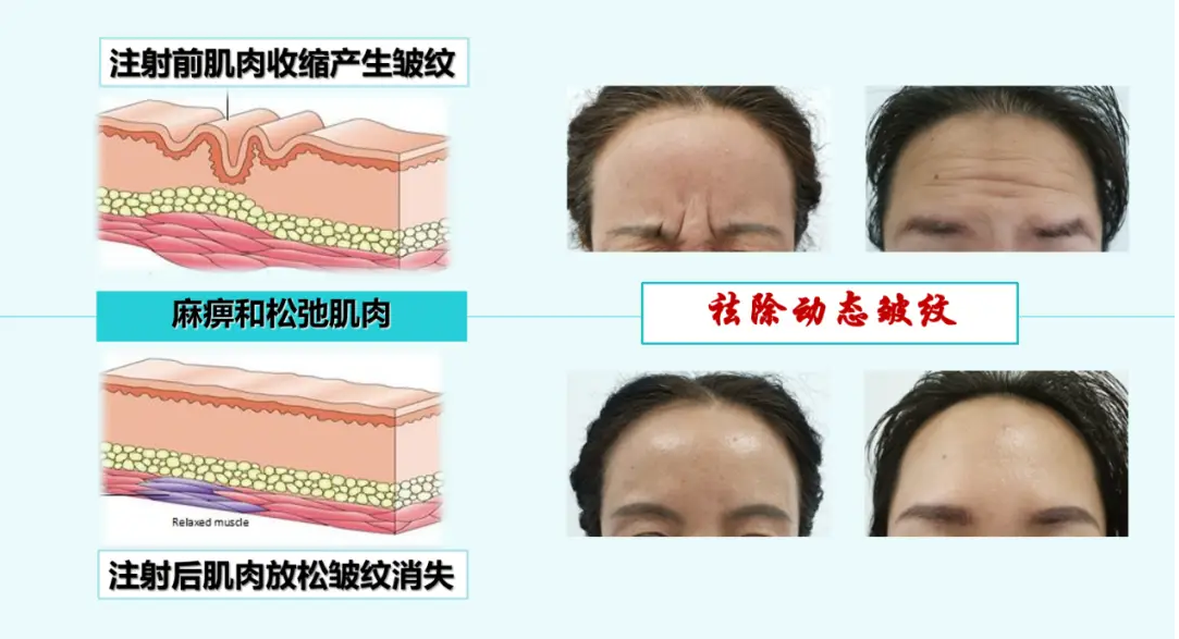 肉毒素的作用与功效是什么