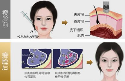 肉毒素的作用与功效是什么