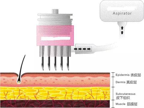 玻尿酸与胶原蛋白填充泪沟哪个更好