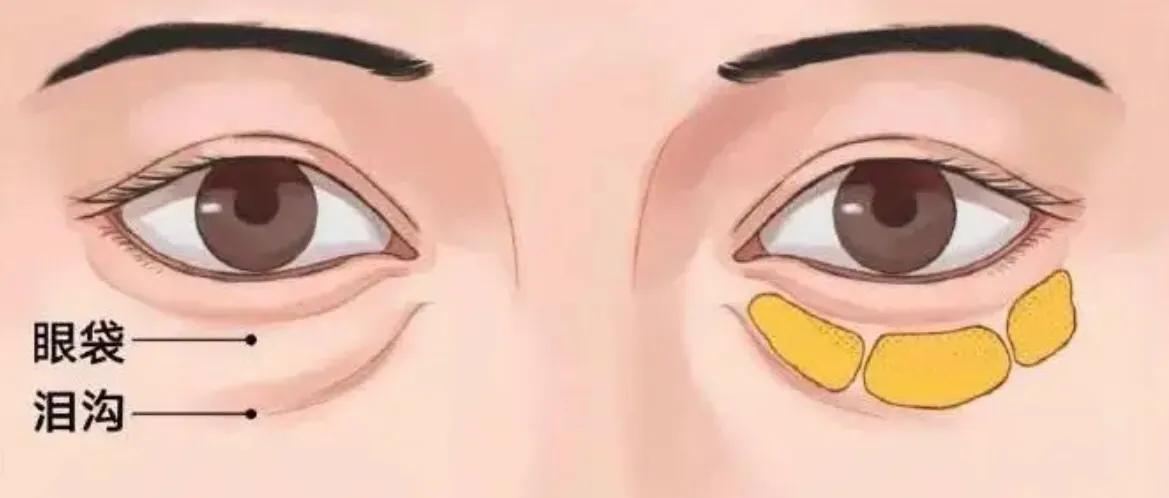 胶原蛋白填充泪沟能维持多久？医生为你揭秘真相