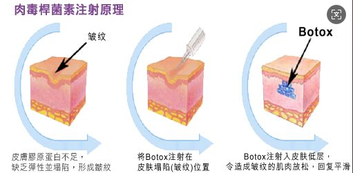 打完肉毒素后，这7件事千万别忽略！