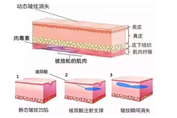 打完肉毒素后，这7件事千万别忽略！