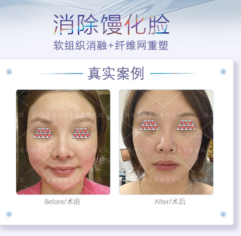 馒化脸是什么原因导致的