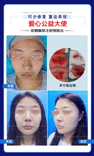 馒化修复怎么做