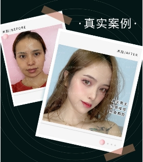 隆鼻能维持多久？这篇说透所有关键点