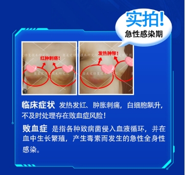 隆胸材料怎么选？变美必看指南