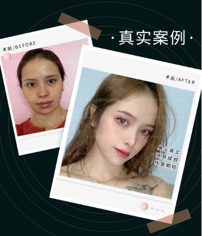 隆鼻用什么材料比较好，比较安全