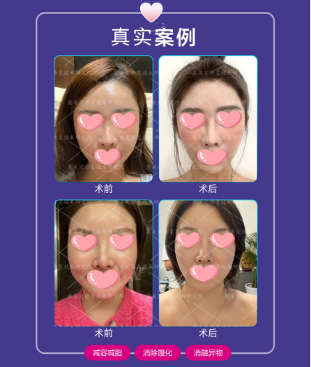 馒化脸SEEK频谱智能清除术修复会有效果吗？