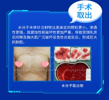 捷克水分子丰胸安全吗