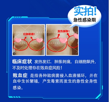 “蜜桃胸”变“定时炸弹”：揭开捷克水分子丰胸的致命陷阱