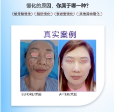 面部馒化要怎么修复