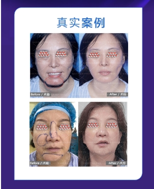 面部填充馒化还能恢复吗