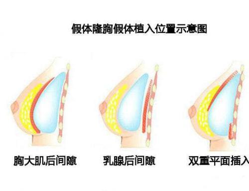 假体隆胸取出费用贵吗