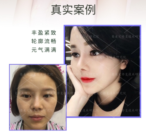 脂肪填充五年后会出现哪些后遗症