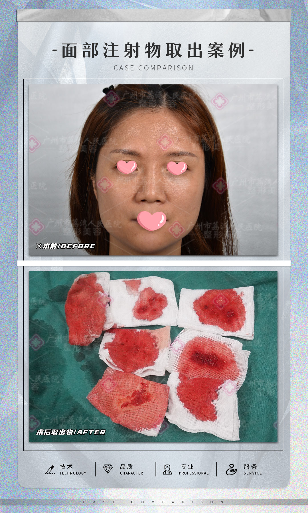 怎么分辨玻尿酸的真假？