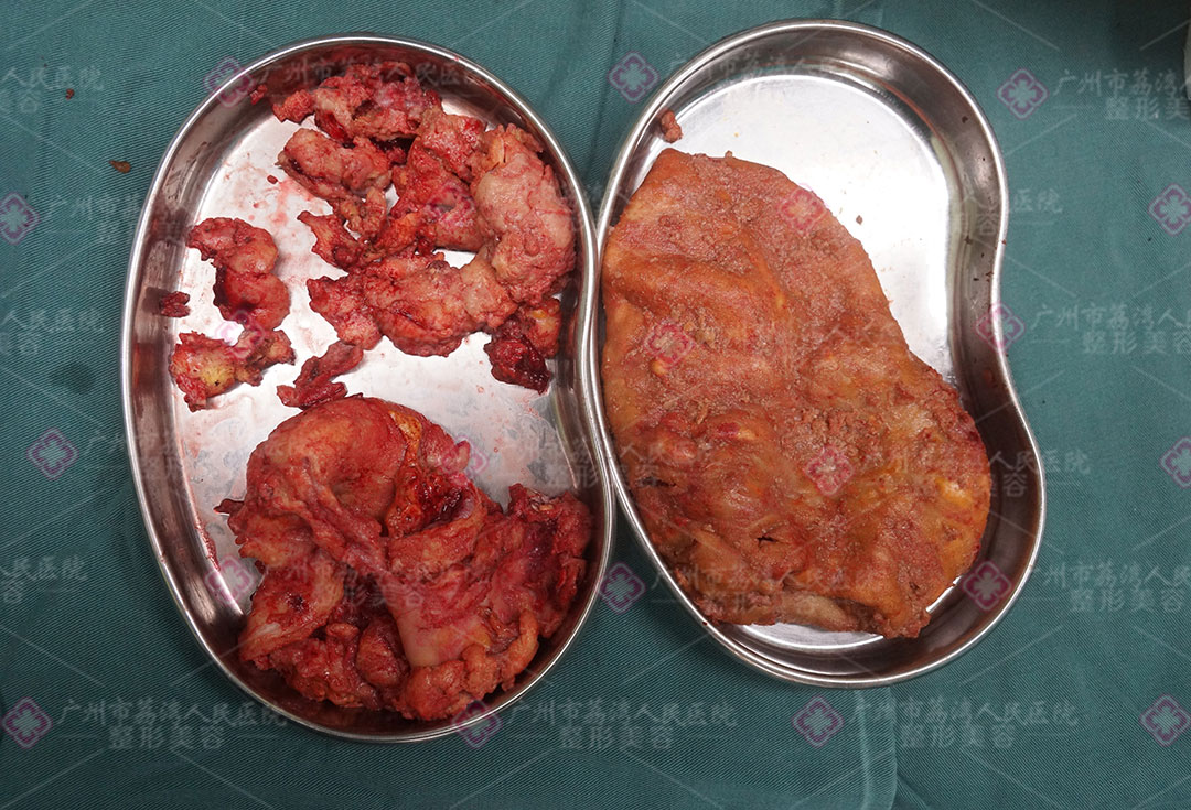 奥美定取出失败怎么办？