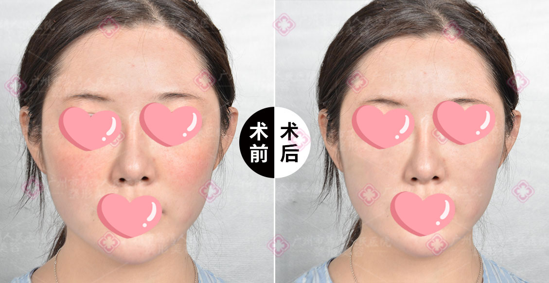 生长因子取出修复医院